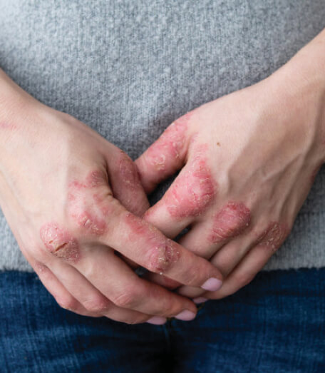 Impacts Of Eczema