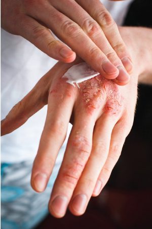 eczema management
