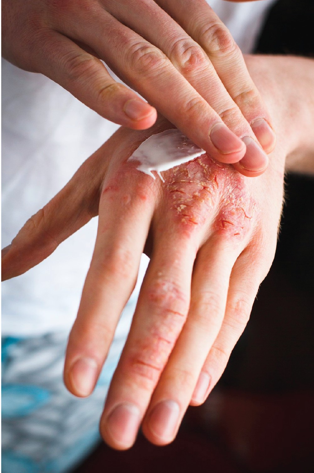 Eczema Management Eczema Support Australia