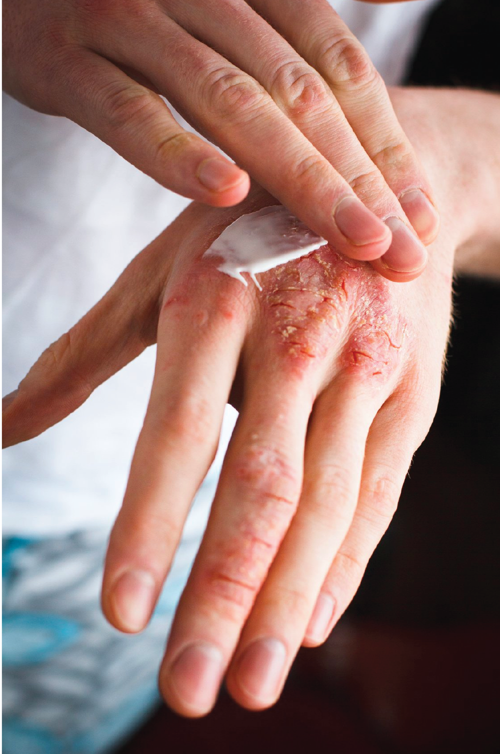 Eczema Management Eczema Support Australia