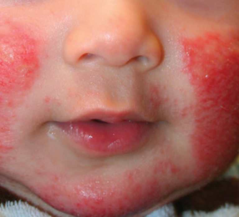 Atopic Dermatitis Atopic Eczema