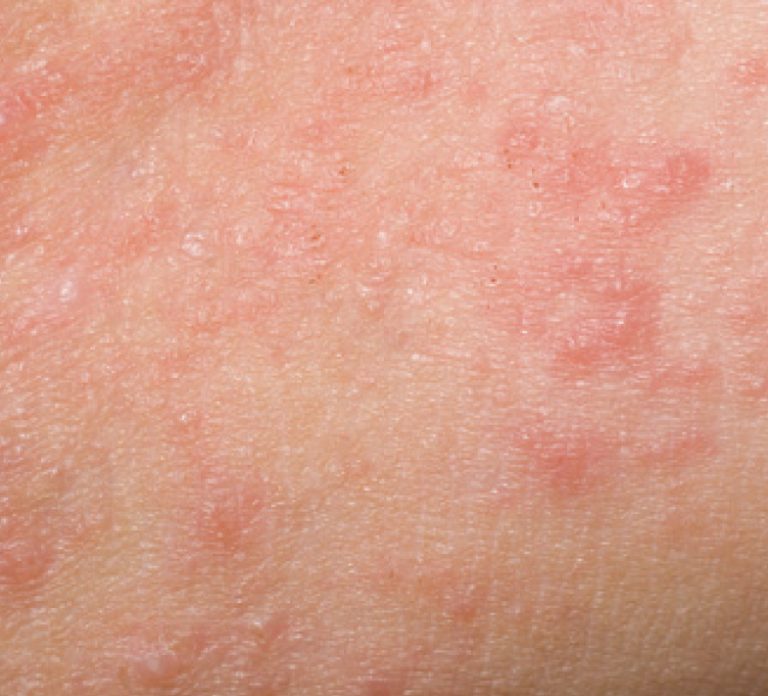 Contact Dermatitis