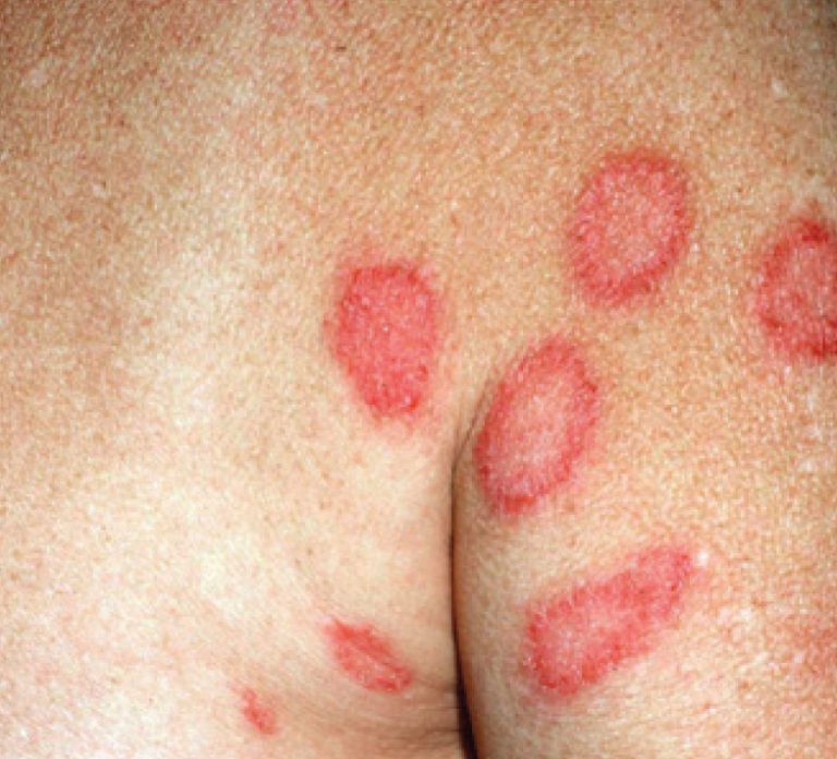 Discoid Eczema