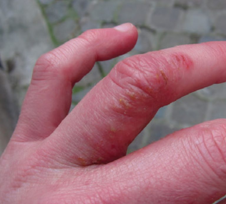 Dyshidrotic Eczema