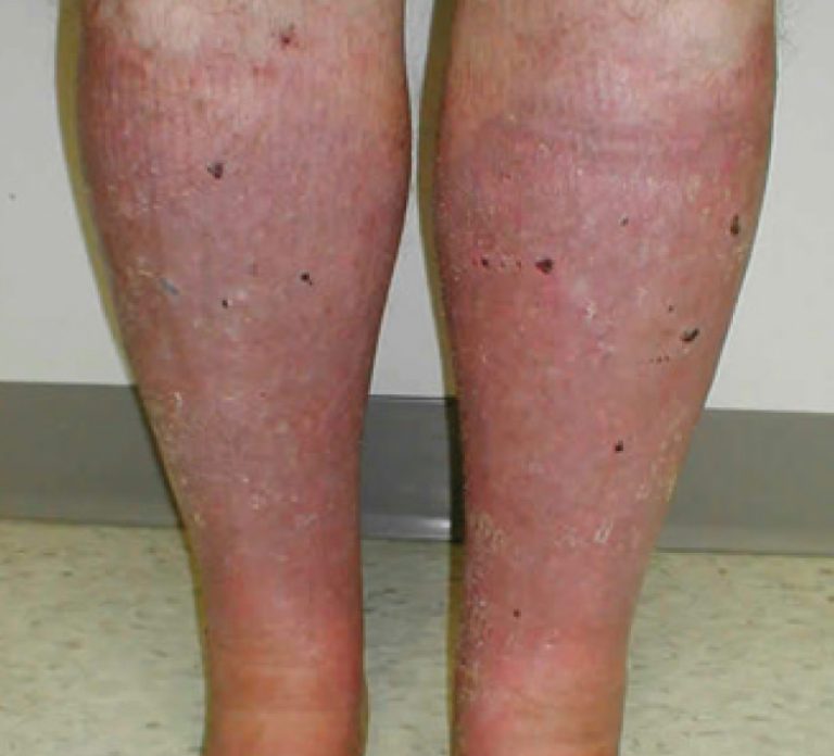 Stasis Dermatitis