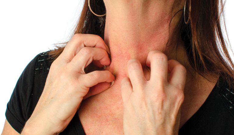 Woman Scratching Neck
