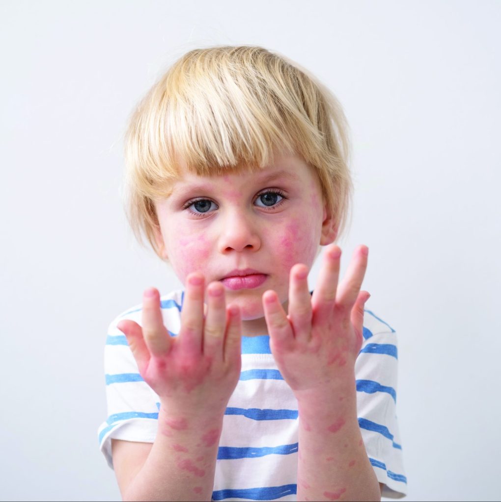 Little Boy With Allergic Rash Eczema Face Hands Severe Allergic Reaction Atopic Skin