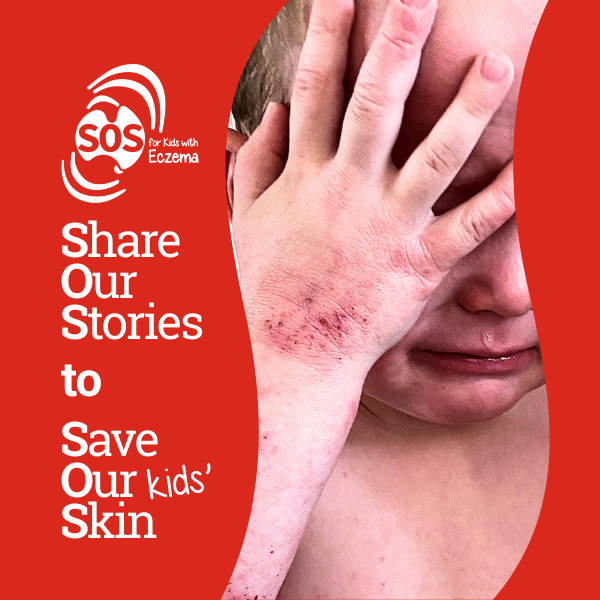 Eczema Support Australia Sos Share Our Stories Sos