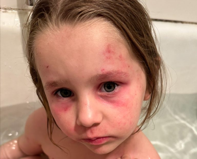 Ally With Sore Eyes From Severe Eczema