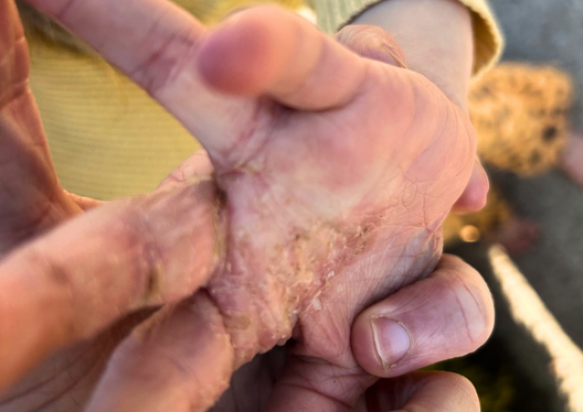 Eczema Support Australia Ways To Give Workplacegiving
