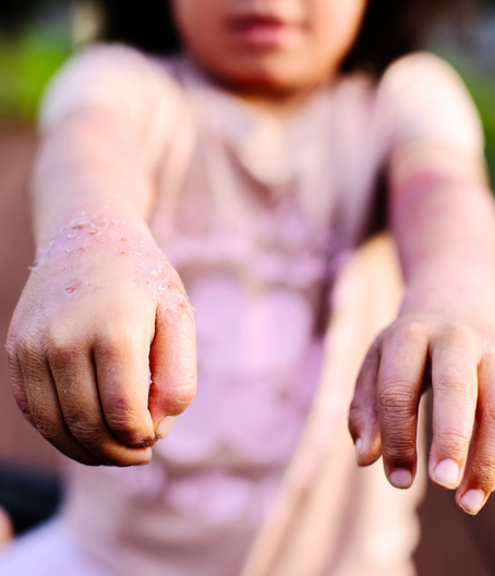 Eczema Support Australia Ways To Give Website Top Image