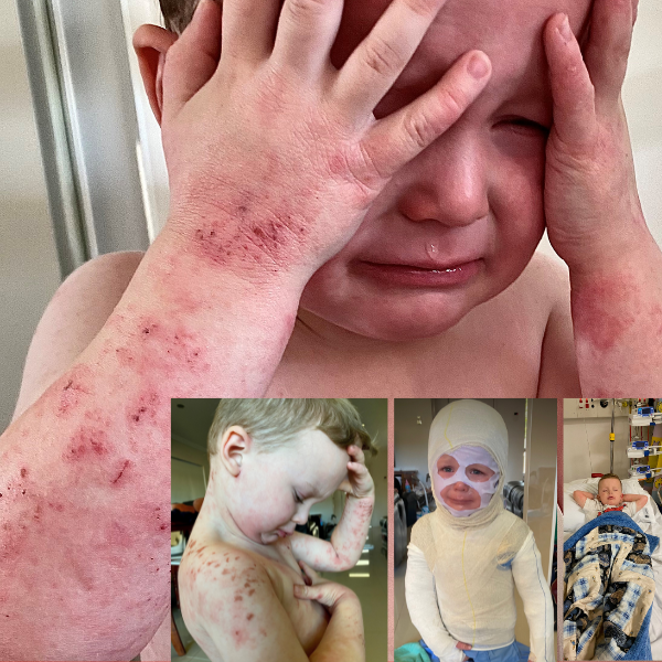 Eczema Support Australia Severe Eczema