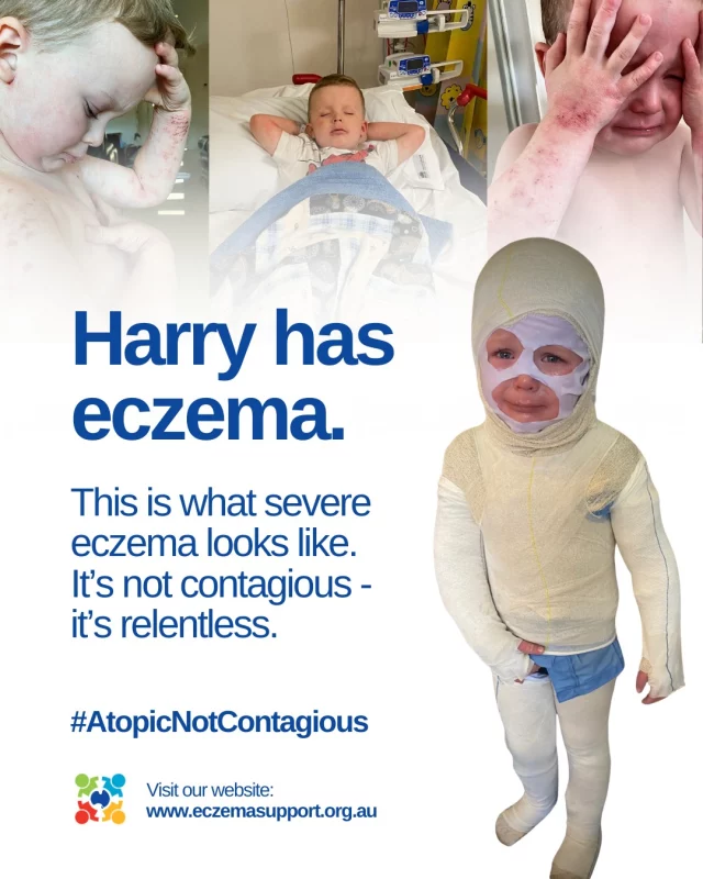 Children like Harry live with pain, hospitalisations, and isolation.
They need treatment options—and they need them now.

#AtopicNotContagious 
#EczemaAwareness #EczemaSupport 

@healthqld @mamamiaaus @markbutlermp @kidspot @gaapporg