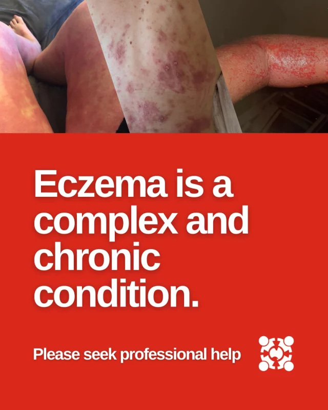 Feeling unsettled by a story you saw in the media about eczema? You're not alone.
⠀
Eczema is a complex, chronic condition that affects millions of Australians — and it’s normal to have questions about how best to care for your or your child’s skin.

Some media stories present alarming personal experiences, but may not reflect the broader medical evidence or the safe and effective use of treatments like topical steroids.

Topical corticosteroids are safe and effective when tailored to the individual and used as prescribed. They remain vital to provide relief, alongside the use of moisturisers and the avoidance of triggers, for many with eczema. Talk with your health professional on how to use these treatments as part of a personalised Eczema Care Plan.

🌱 If you're feeling unsure or overwhelmed, take a breath. You're doing a great job.
📋 Visit our website for more information (link in bio)  and speak to a trusted health professional before making changes to your treatment.
⠀
You're not alone — we're here for you. 💙
⠀
#EczemaSupport #EczemaCarePlan #SkinHealth #TopicalSteroids #TrustTheScience #EczemaCommunity #HealthLiteracy #EvidenceBasedCare